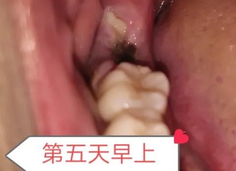 拔智齿洞恢复过程14天图解(拔牙7天恢复图解详情) 拔智齿洞恢复过程14天图解(拔牙7天恢复图解详情)