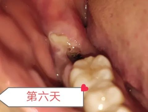 拔智齿洞恢复过程14天图解(拔牙7天恢复图解详情) 拔智齿洞恢复过程14天图解(拔牙7天恢复图解详情)