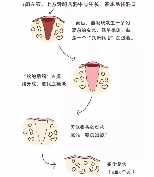 拔智齿洞恢复过程14天图解(拔牙7天恢复图解详情) 拔智齿洞恢复过程14天图解(拔牙7天恢复图解详情)