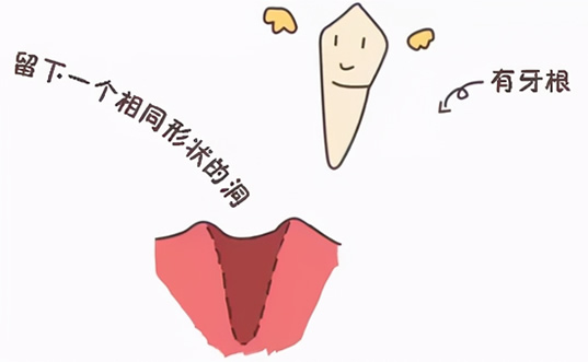 拔智齿洞恢复过程14天图解(拔牙7天恢复图解详情) 拔智齿洞恢复过程14天图解(拔牙7天恢复图解详情)