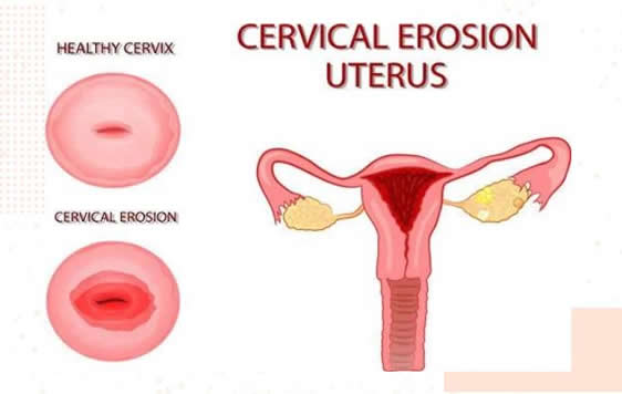 女性hpv最明显的征兆(汇总hpv自查的10个方法) 女性hpv最明显的征兆(汇总hpv自查的10个方法)