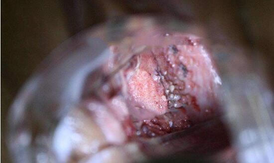 真实女性hpv感染初期图?女性hpv图片样子及症状