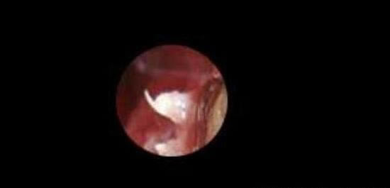 真实女性hpv感染初期图?女性hpv图片样子及症状