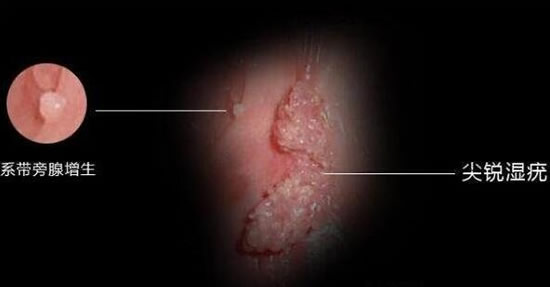 真实女性hpv感染初期图?女性hpv图片样子及症状
