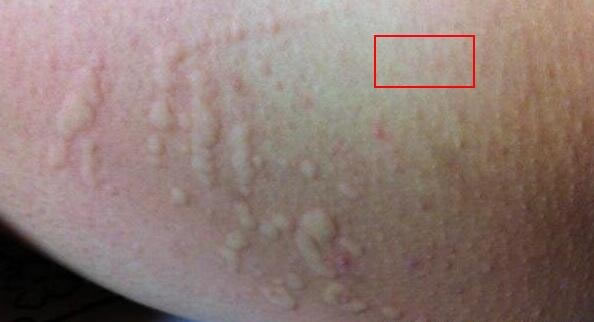 合集18种常见的皮肤病图片(皮肤病照片查病)