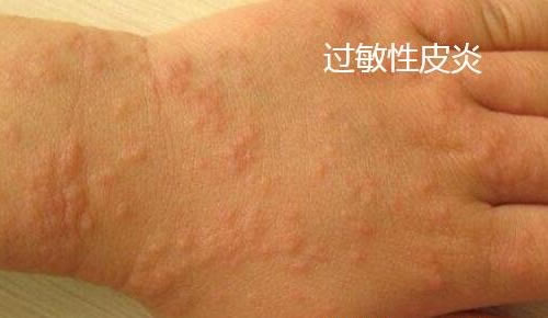 合集18种常见的皮肤病图片(皮肤病照片查病)