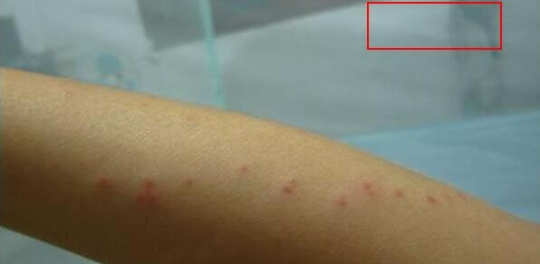 合集18种常见的皮肤病图片(皮肤病照片查病)