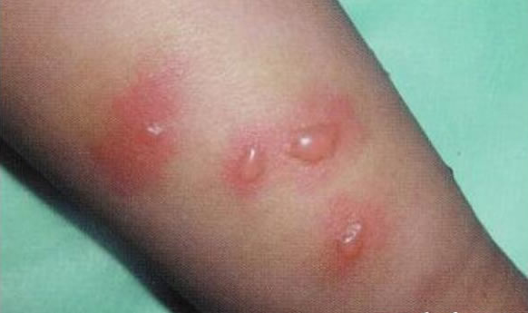 合集18种常见的皮肤病图片(皮肤病照片查病)