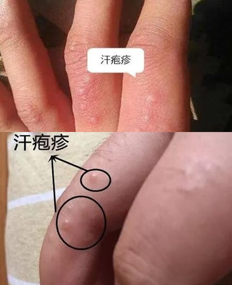 合集18种常见的皮肤病图片(皮肤病照片查病)