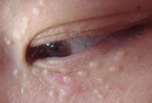 合集18种常见的皮肤病图片(皮肤病照片查病)