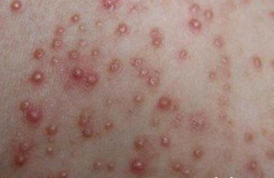 合集18种常见的皮肤病图片(皮肤病照片查病)