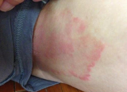 合集18种常见的皮肤病图片(皮肤病照片查病)