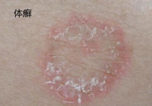 合集18种常见的皮肤病图片(皮肤病照片查病)