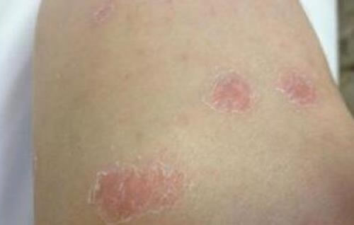 合集18种常见的皮肤病图片(皮肤病照片查病)