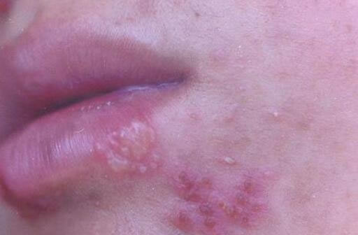 合集18种常见的皮肤病图片(皮肤病照片查病)