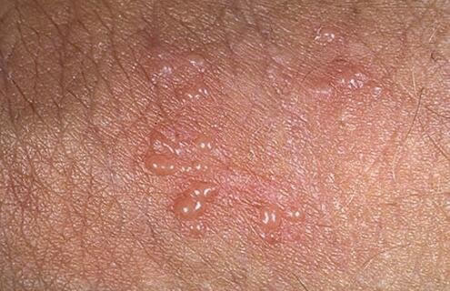 合集18种常见的皮肤病图片(皮肤病照片查病)