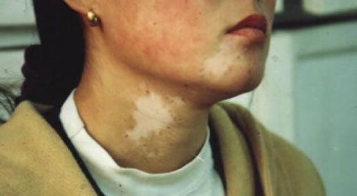 合集18种常见的皮肤病图片(皮肤病照片查病)