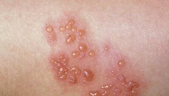 合集18种常见的皮肤病图片(皮肤病照片查病)