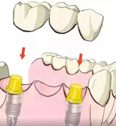 医院种植牙一颗多少钱(从6千到3万不等)