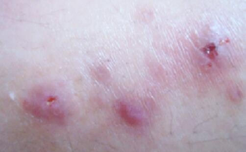 什么是花柳病图片是什么样子 花柳病简介