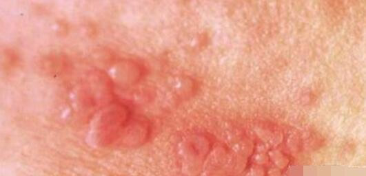 什么是花柳病图片是什么样子 花柳病简介