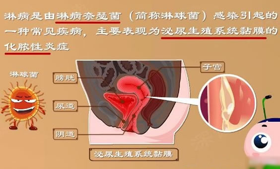 什么是花柳病图片是什么样子 花柳病简介