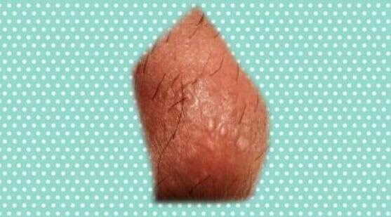 什么是花柳病图片是什么样子 花柳病简介