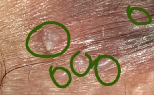 什么是花柳病图片是什么样子 花柳病简介