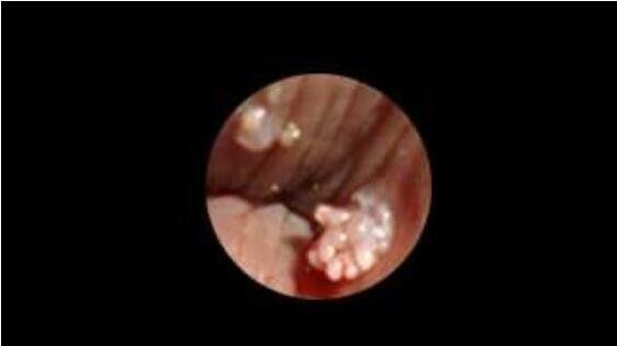 什么是花柳病图片是什么样子 花柳病简介