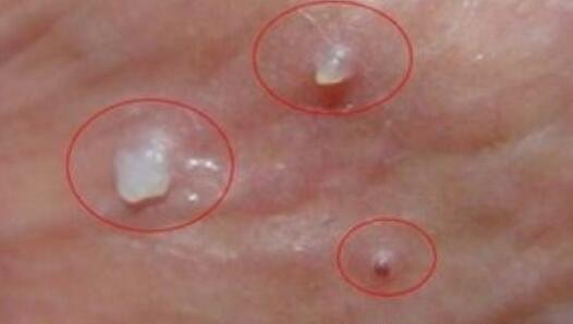 什么是花柳病图片是什么样子 花柳病简介