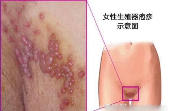 什么是花柳病图片是什么样子 花柳病简介