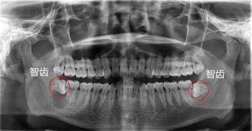智齿应该拔掉吗?对身体究竟有没有害 智齿应该拔掉吗?对身体究竟有没有害