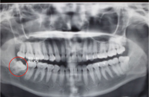 智齿应该拔掉吗?对身体究竟有没有害 智齿应该拔掉吗?对身体究竟有没有害