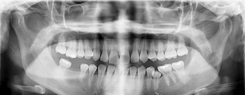智齿应该拔掉吗?对身体究竟有没有害 智齿应该拔掉吗?对身体究竟有没有害