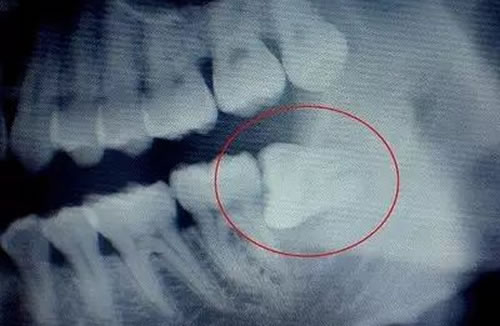 智齿应该拔掉吗?对身体究竟有没有害 智齿应该拔掉吗?对身体究竟有没有害