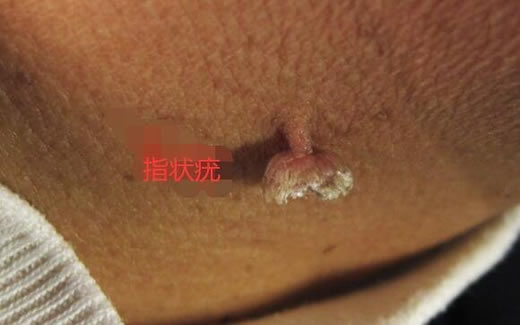 女性hpv病毒女性症状图片 各类型初期小疣体图片