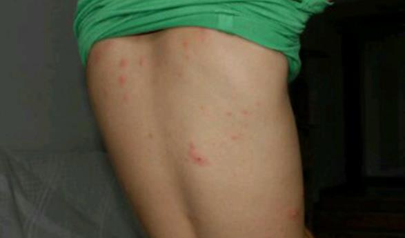 水痘初期症状图片 水痘初期后期症状介绍 水痘初期症状图片 水痘初期后期症状介绍