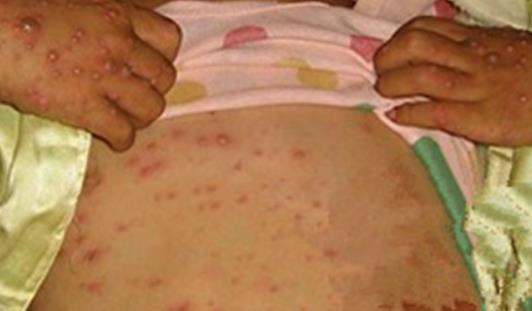 水痘初期症状图片 水痘初期后期症状介绍 水痘初期症状图片 水痘初期后期症状介绍