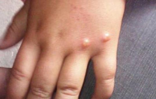 水痘初期症状图片 水痘初期后期症状介绍 水痘初期症状图片 水痘初期后期症状介绍