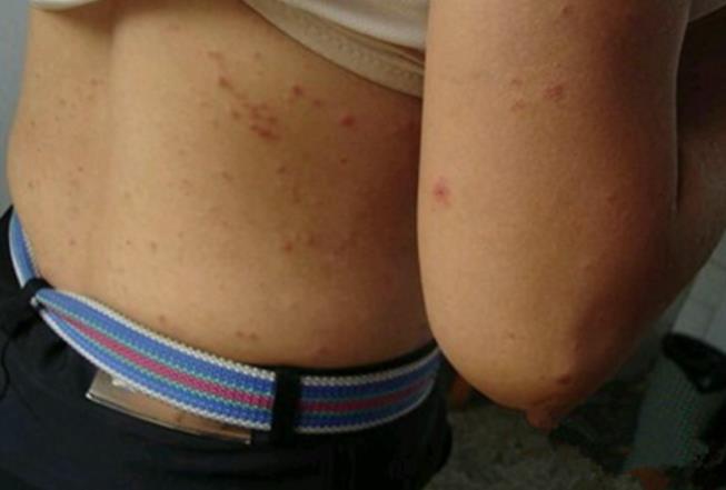 水痘初期症状图片 水痘初期后期症状介绍 水痘初期症状图片 水痘初期后期症状介绍