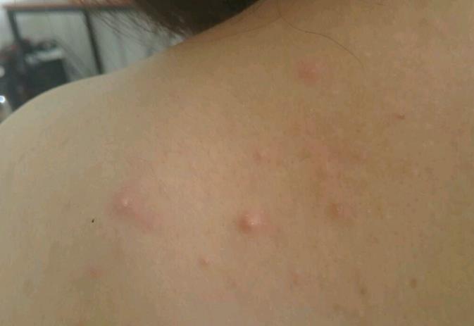 水痘初期症状图片 水痘初期后期症状介绍 水痘初期症状图片 水痘初期后期症状介绍