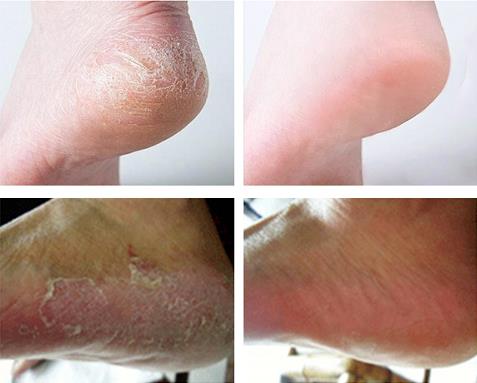 脚气脚痒试试这3种方法(脚气脚痒三种克星)