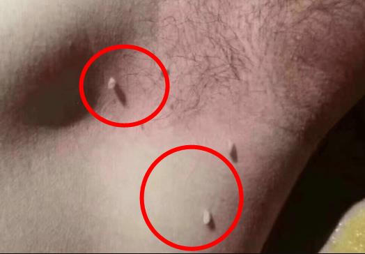 千万别把丝状疣想象的太严重 丝状疣严重吗？