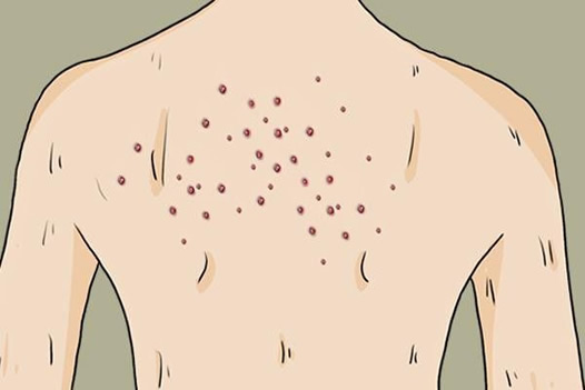 女性hpv明显的三个症状 女性感染hpv的症状