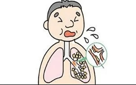 从痰液颜色看身体健康(9种痰颜色代表的疾病) 从痰液颜色看身体健康(9种痰颜色代表的疾病)