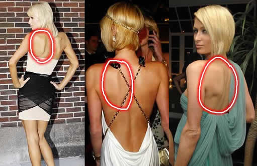 蝴蝶骨是什么样子的图片 具体在什么位置？