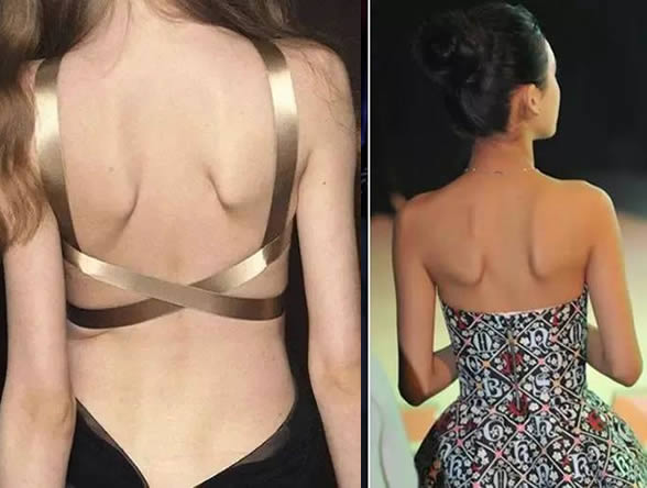 蝴蝶骨是什么样子的图片 具体在什么位置？