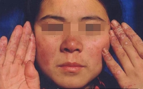 红疮狼斑早期图片 红斑狼疮7大症状解读