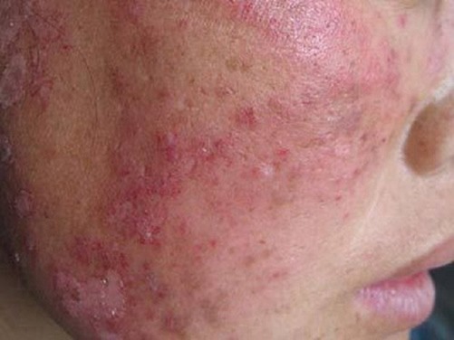 红疮狼斑早期图片 红斑狼疮7大症状解读