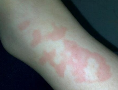 红疮狼斑早期图片 红斑狼疮7大症状解读